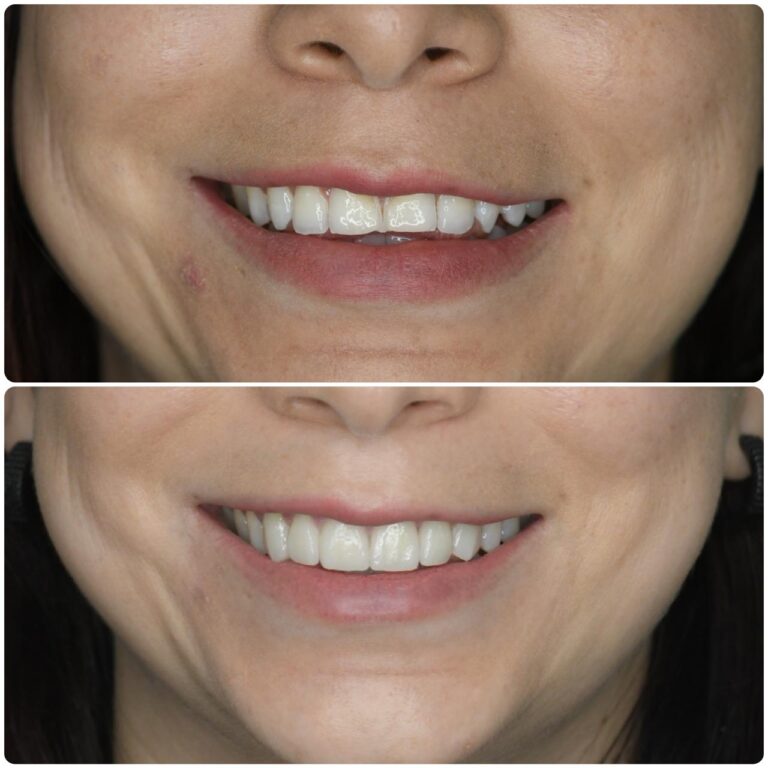 smile_makeover_11