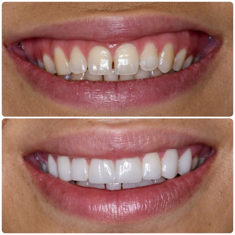 smile_makeover_3
