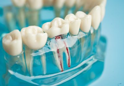 latest-innovations-root-canal-therapy